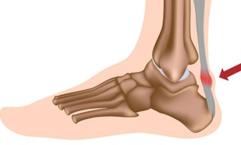 Trẻ đi nhón chân và chậm nói là bị gì Trẻ đi nhón chân và chậm nói là bị gì